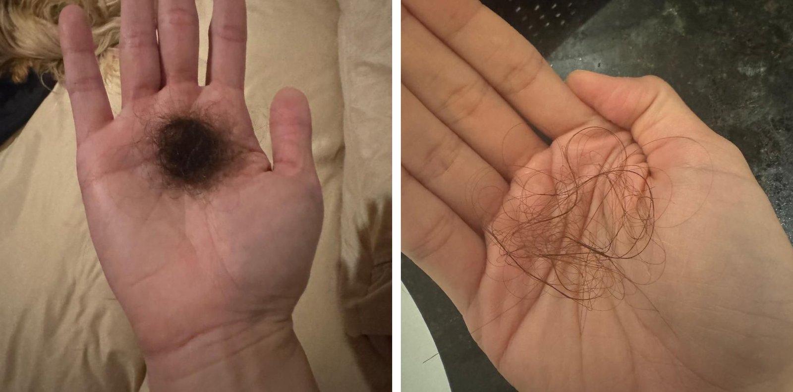 Duas fotos da mão de uma paciente com cabelo caído no banho, antes e depois do tratamento